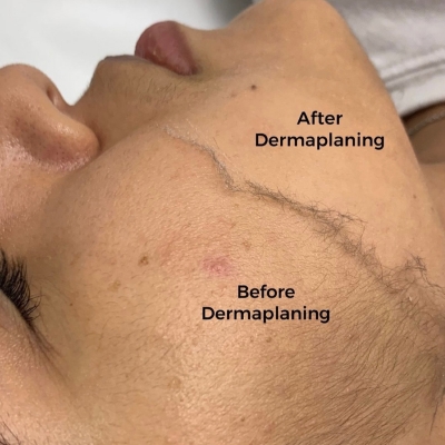 Dermaplaning